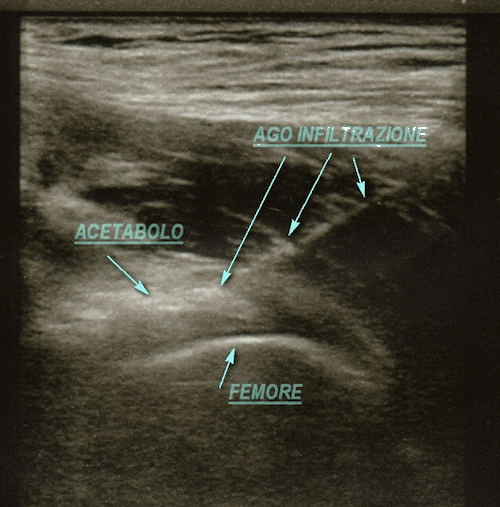 Dr Membrino-infiltrazione anca - viscosupplementazione