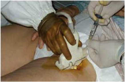Dr Membrino-infiltrazione anca - viscosupplementazione
